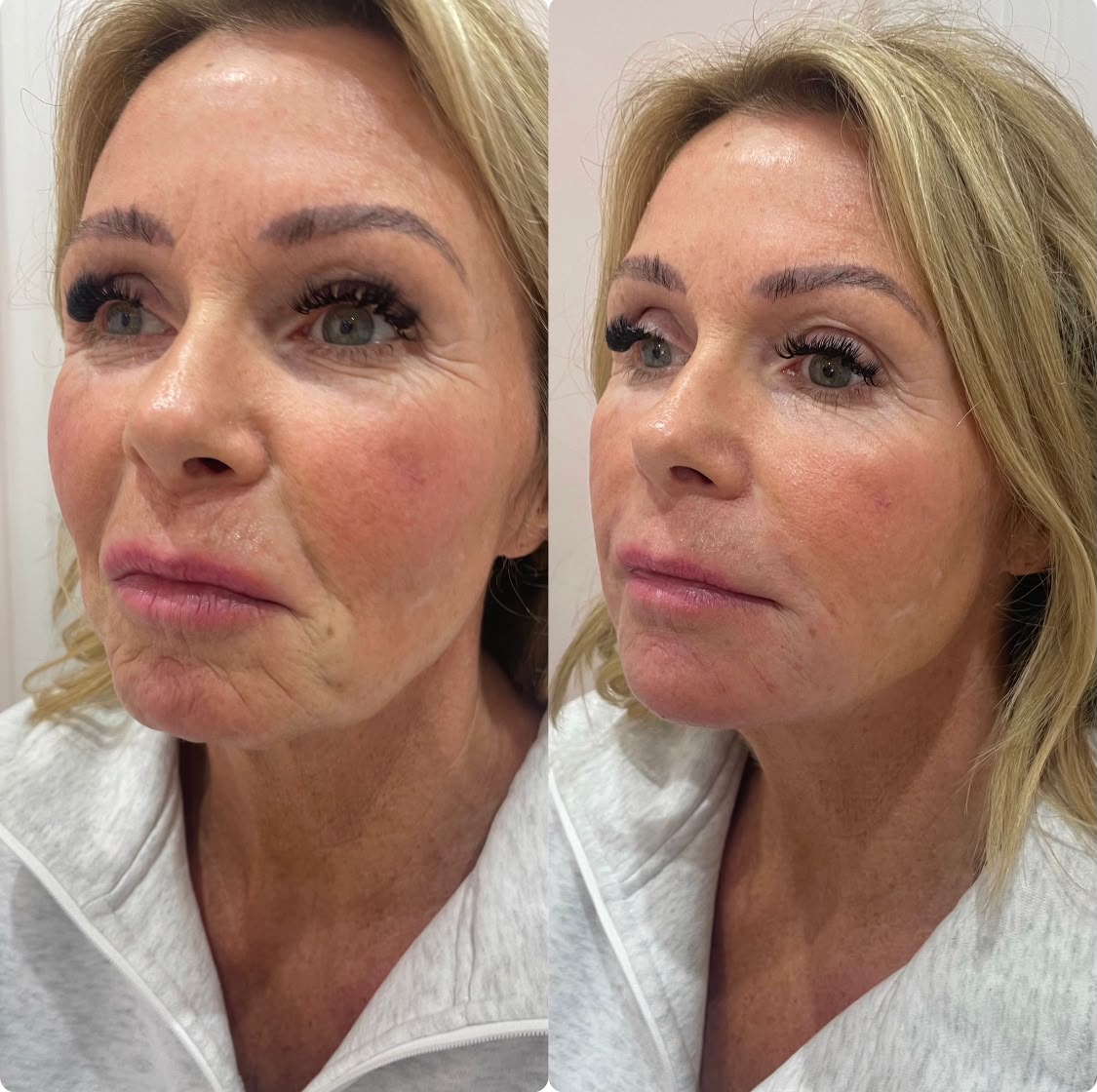 Before and after lower face and jawline filler at Jorja Aesthetics