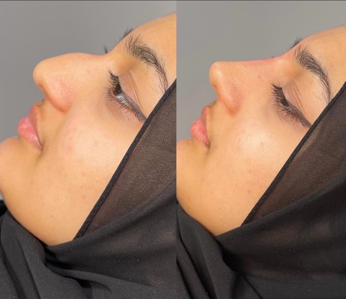 Before and after non surgical rhinoplasty at Jorja Aesthetics
