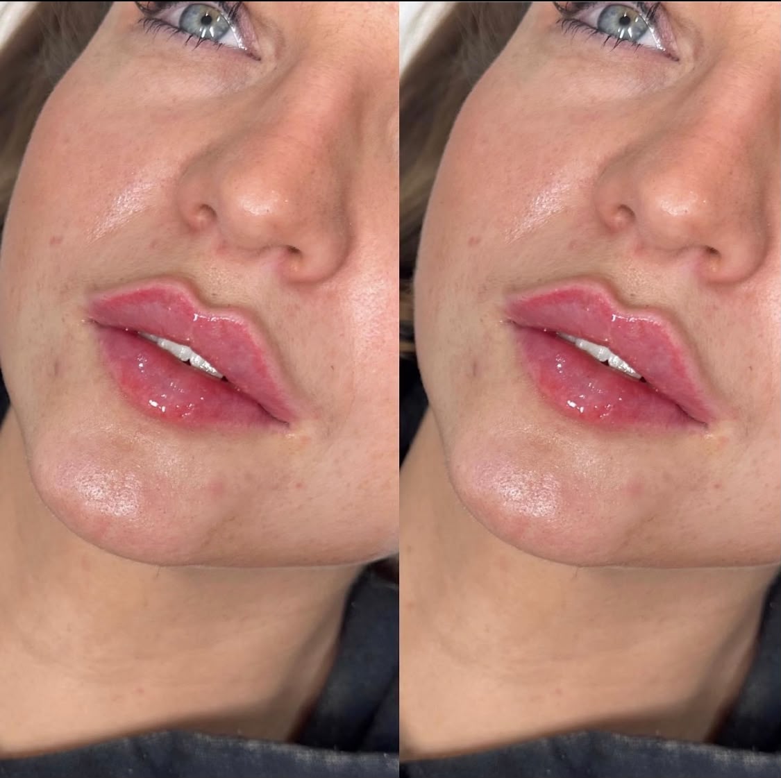 Before and after Russian lip filler, side view, at Jorja Aesthetics