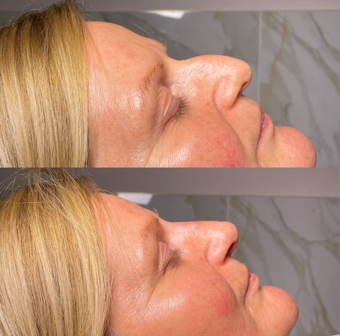 Before and after non surgical rhinoplasty, profile view, at Jorja Aesthetics