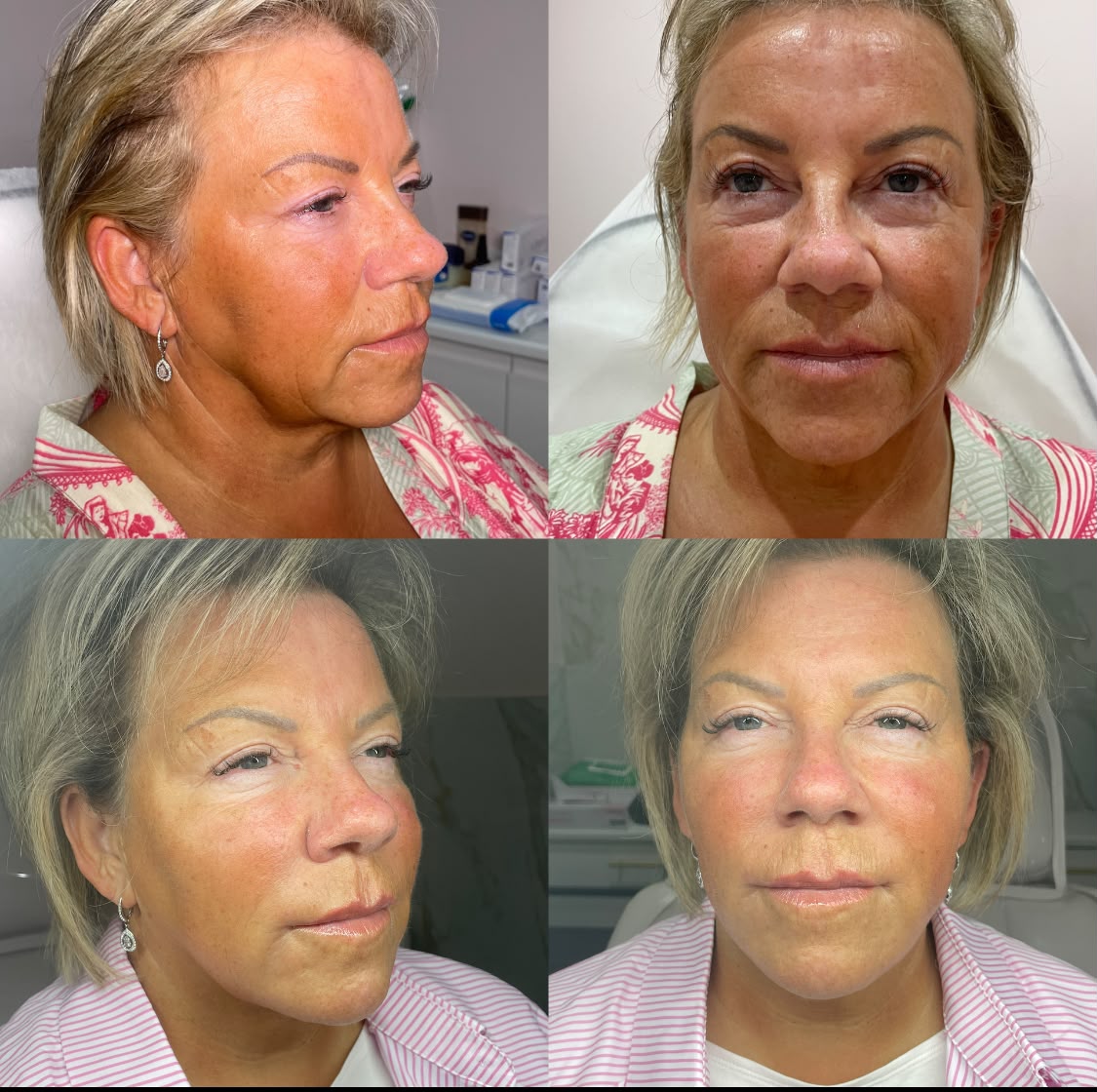 Before and after full face rejuvenation with 5ml of filler at Jorja Aesthetics