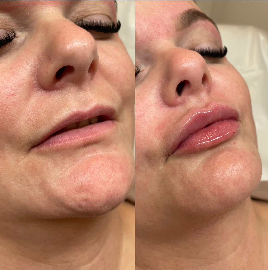 Before and after Russian lip filler, close up, at Jorja Aesthetics