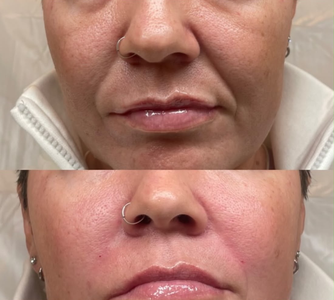 Before and after facial filler 1ml at Jorja Aesthetics