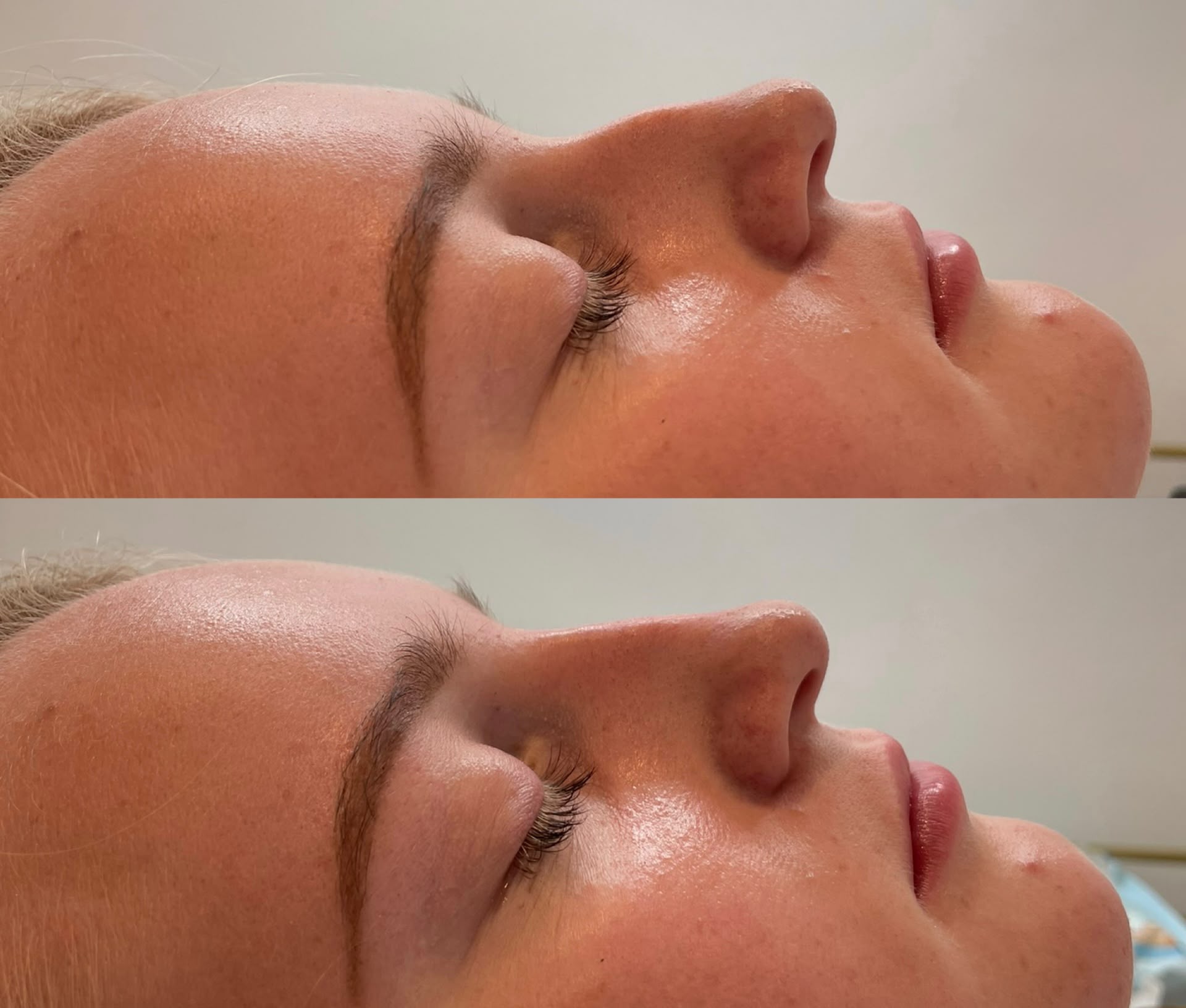 Before and after non surgical rhinoplasty, side profile, at Jorja Aesthetics