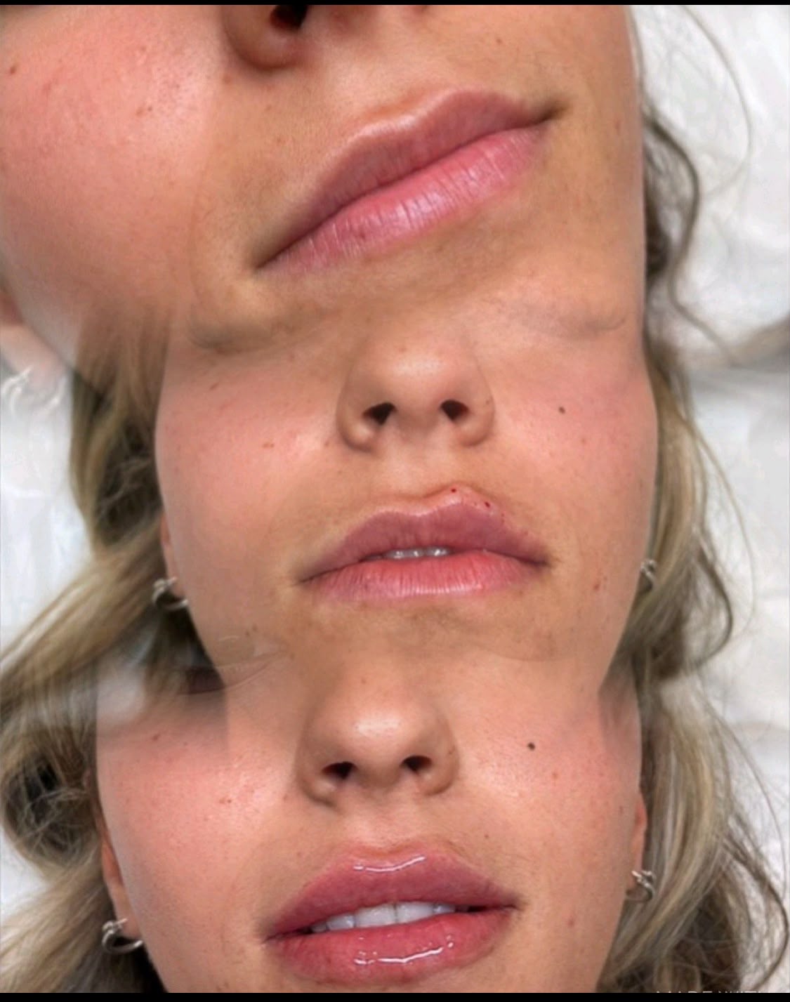 Before and after Russian lip filler at Jorja Aesthetics